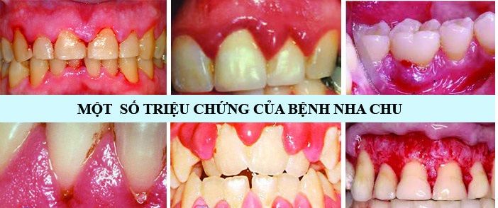 Bệnh nha chu và phương pháp điều trị - Bệnh viện 108