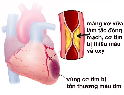 Những dấu hiệu sớm cảnh báo nhồi máu cơ tim cấp - Bệnh viện 108