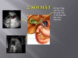 Sỏi túi mật và cách xử trí - Bệnh viện 108