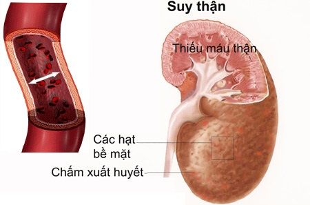 Dấu hiệu bệnh thận và suy thận - Bệnh viện 108