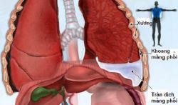 Tràn dịch màng phổi - Bệnh viện 108