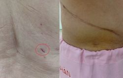 Lấy sỏi thận qua da đường hầm nhỏ bằng Laser - Bệnh viện 108