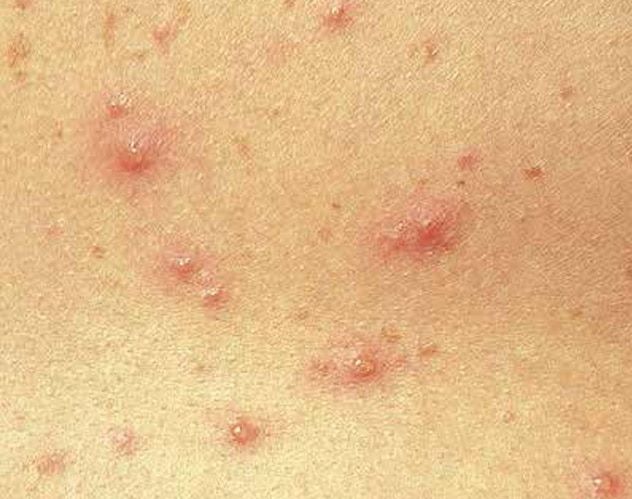 Triệu chứng của bệnh thuỷ đậu và cách phòng ngừa - Bệnh viện 108