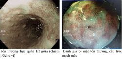 Điều trị ung thư thực quản sớm bằng phương pháp cắt tách hạ niêm mạc qua nội soi (Endoscopic submucosal dissection) - Bệnh viện 108