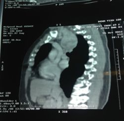 Cắt bướu giáp thòng trung thất qua đường cổ, hơn 5 năm kinh nghiệm, nhân một trường hợp