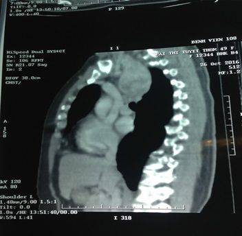 Cắt bướu giáp thòng trung thất qua đường cổ, hơn 5 năm kinh nghiệm, nhân một trường hợp