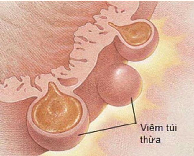 Một số điểm cần biết về viêm túi thừa manh tràng - Bệnh viện 108