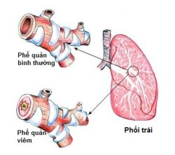 Viêm phế quản cấp - Bệnh viện 108