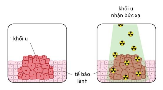 Quy trình xạ trị ung thư - Bệnh viện 108