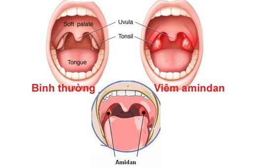 Viêm amidan - Bệnh viện 108