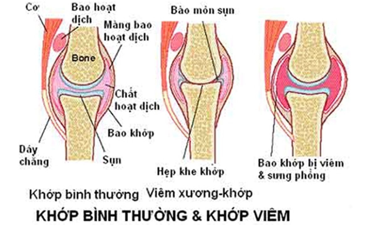 Vai trò của siêu âm trong chẩn đoán bệnh thoái hóa khớp gối - Bệnh viện 108