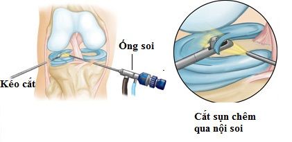Nhận biết và điều trị rách sụn chêm khớp gối - Bệnh viện 108