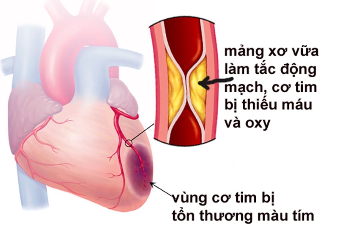 Những dấu hiệu sớm cảnh báo nhồi máu cơ tim - Bệnh viện 108