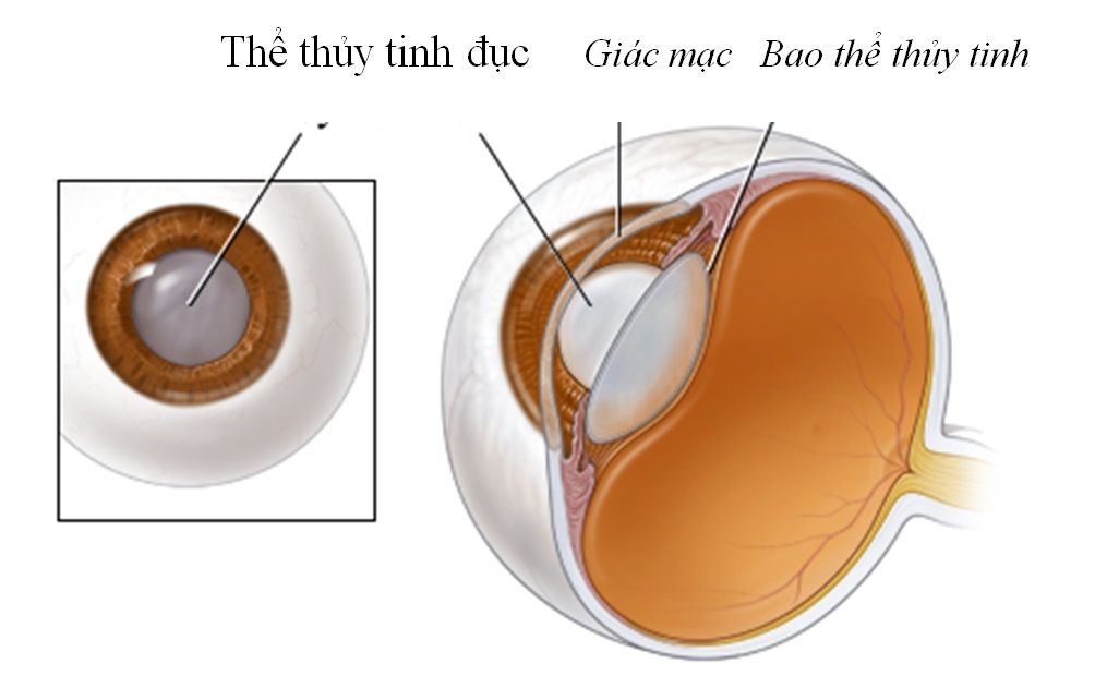 Bệnh đục thủy tinh thể và biện pháp phòng ngừa - Bệnh viện 108