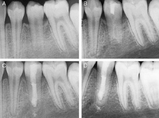 Điều trị nội nha răng vĩnh viễn chưa đóng cuống bằng MTA - Bệnh viện 108