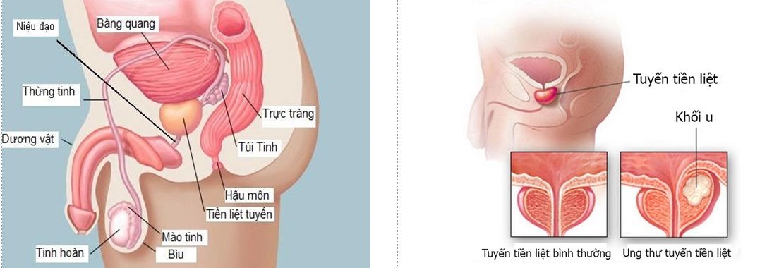 Kỹ thuật xạ trị điều biến liều điều trị ung thư tiền liệt tuyến - Bệnh viện 108