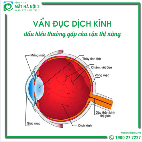 VẨN ĐỤC DỊCH KÍNH: dấu hiệu thường gặp của cận thị nặng