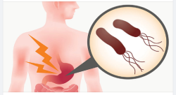 VI KHUẨN H- THỦ PHẠM GÂY RA NHỮNG BỆNH LÝ NGUY HIỂM NÀO?