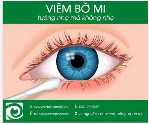 Viêm bờ mi: Tưởng nhẹ mà không nhẹ