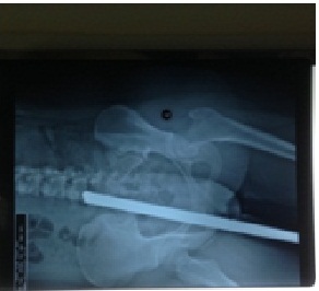 Nữ sinh đi xe đạp điện bị tai nạn do thanh sắt đâm thấu mông. - Bệnh viện VIệt Đức