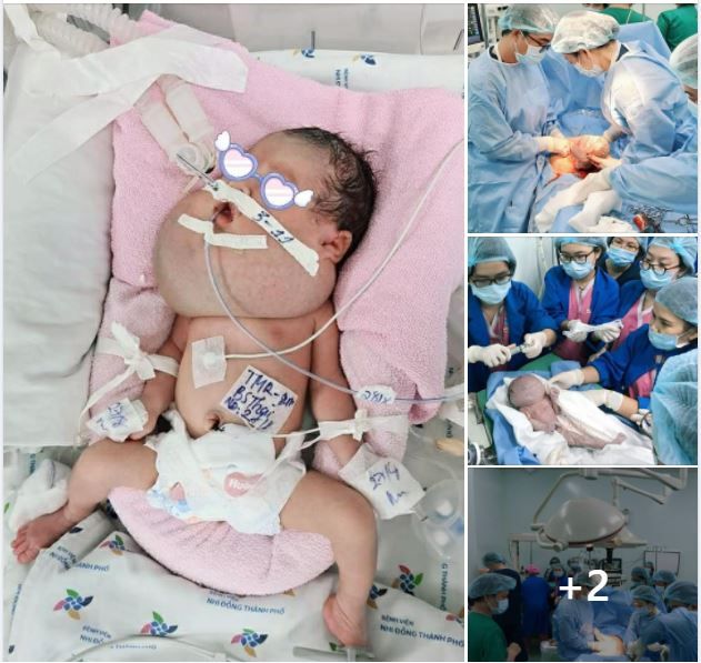 VƯỢT 15 CÂY SỐ CHUYỂN VIỆN AN TOÀN, PHỐI HỢP CỨU SỐNG MỘT CA DỊ TẬT SƠ SINH PHỨC TẠP, U VÙNG MẶT CỔ KHỔNG LỒ TỪ TRONG BỤNG MẸ