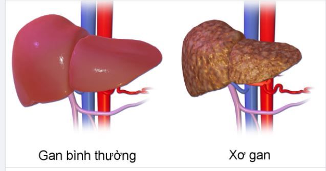 NHỮNG THỦ PHẠM DẪN ĐẾN XƠ GAN