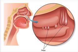 POLYP MŨI CÓ NGUY HIỂM KHÔNG?