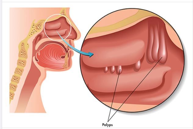 POLYP MŨI CÓ NGUY HIỂM KHÔNG?