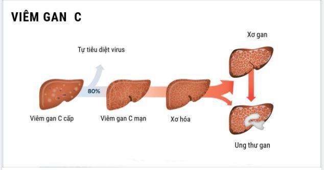 VÌ SAO VIÊM GAN C ĐƯỢC GỌI LÀ “KẺ GIẾT NGƯỜI THẦM LẶNG”?