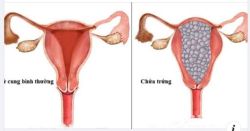 BỆNH NHÂN 50 TUỔI PHẢI CẮT TOÀN BỘ TỬ CUNG KHI CÓ THAI NGHÉN BẤT THƯỜNG