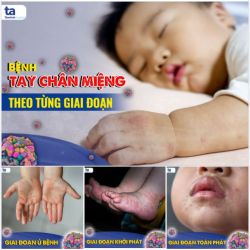 TAY CHÂN MIỆNG: LẠI MỘT MÙA DỊCH BỆNH NGUY HIỂM & KHÔNG THỂ CHỦ QUAN