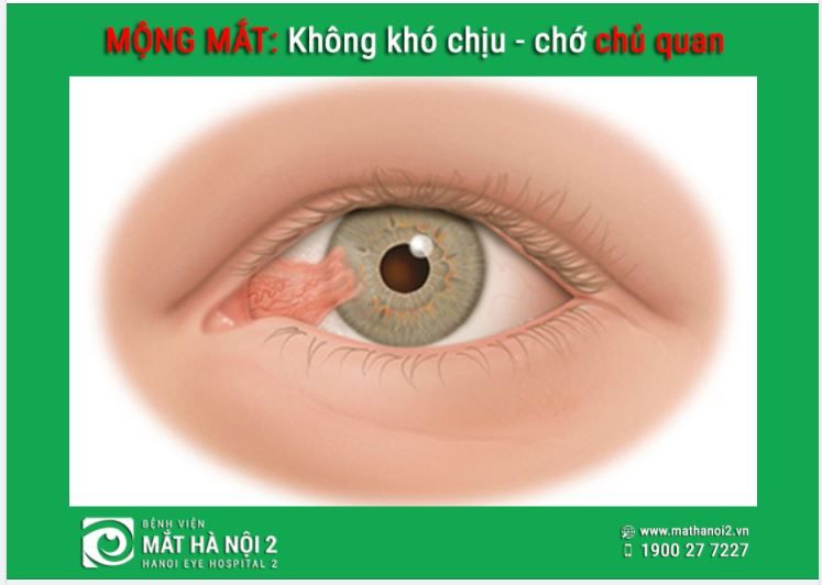 MỘNG MẮT: Không khó chịu nhưng chớ chủ quan