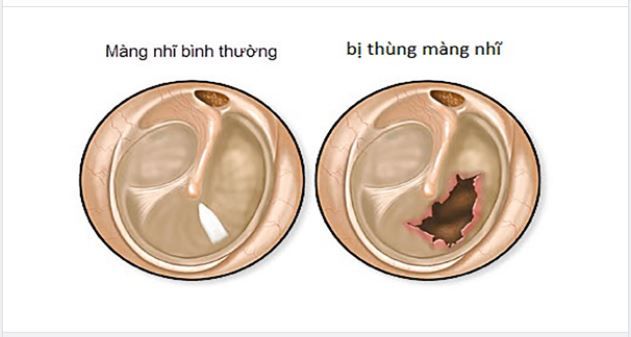 THỦNG MÀNG NHĨ VÀ NHỮNG ĐIỀU CẦN BIẾT