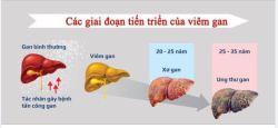 NGƯỜI VIÊM GAN B DỄ CÓ NGUY CƠ BỊ UNG THƯ GAN?