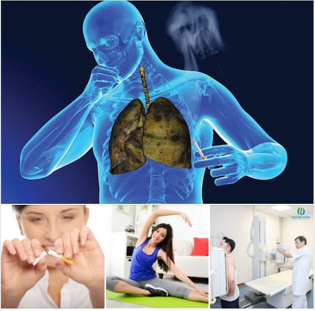 UNG THƯ PHỔI - LÀM SAO ĐỂ PHÒNG NGỪA?