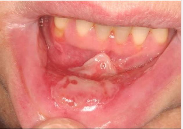 NHẬN BIẾT TRIỆU CHỨNG, ĐIỀU TRỊ HIỆU QUẢ VIÊM NIÊM MẠC MIỆNG