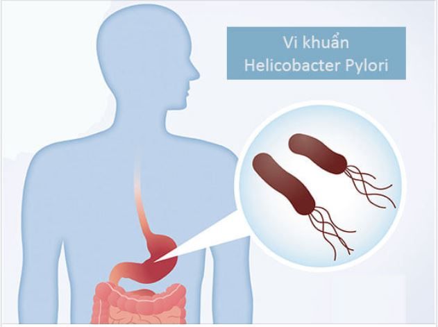 NHỮNG SAI LẦM NGƯỜI BỆNH THƯỜNG MẮC PHẢI KHI ĐIỀU TRỊ ĐAU DẠ DÀY DO VI KHUẨN HP