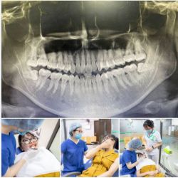 ĐỪNG ĐỂ RĂNG KHÔN GÂY RA BIẾN CHỨNG MỚI ĐI NHỔ