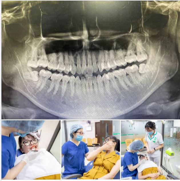 ĐỪNG ĐỂ RĂNG KHÔN GÂY RA BIẾN CHỨNG MỚI ĐI NHỔ