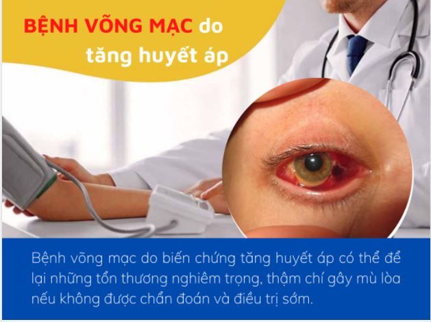 CẢNH GIÁC BIẾN CHỨNG VÕNG MẠC DO TĂNG HUYẾT ÁP