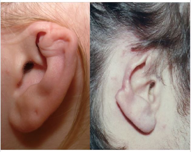 Bấm khuyên vành tai, cẩn trọng biến chứng nguy hiểm