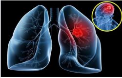 Ung thư phổi nguy hiểm như thế nào?