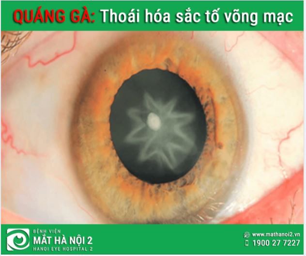 QUÁNG GÀ: Thoái hóa sắc tố võng mạc