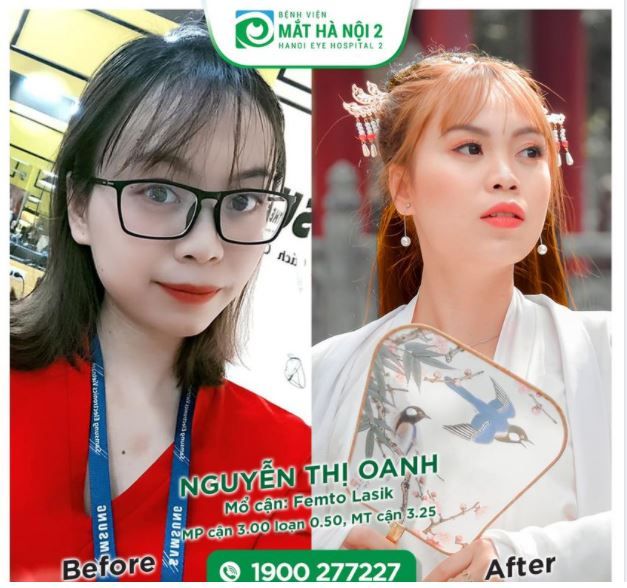 FEMTO LASIK - Phương pháp mổ cận được nhiều người lựa  chọn