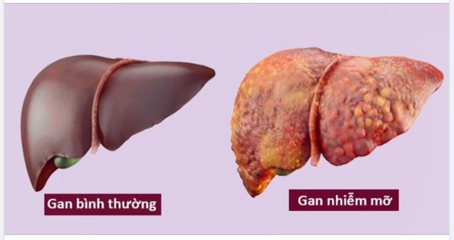 TRIỆU CHỨNG BỆNH GAN NHIỄM MỠ TỪNG GIAI ĐOẠN