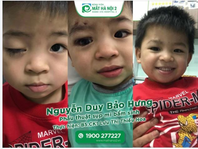 PHẪU THUẬT THÀNH CÔNG CA SỤP MI BẨM SINH CHO BỆNH NHÂN NHÍ 3 TUỔI