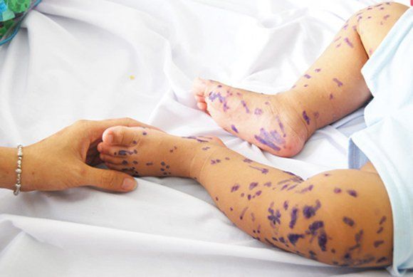 Chăm sóc và vệ sinh miệng của trẻ đang bị tay chân miệng