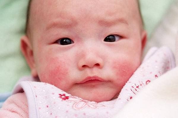 Chú ý dưỡng ẩm khi chăm sóc da ở trẻ bị viêm da cơ địa