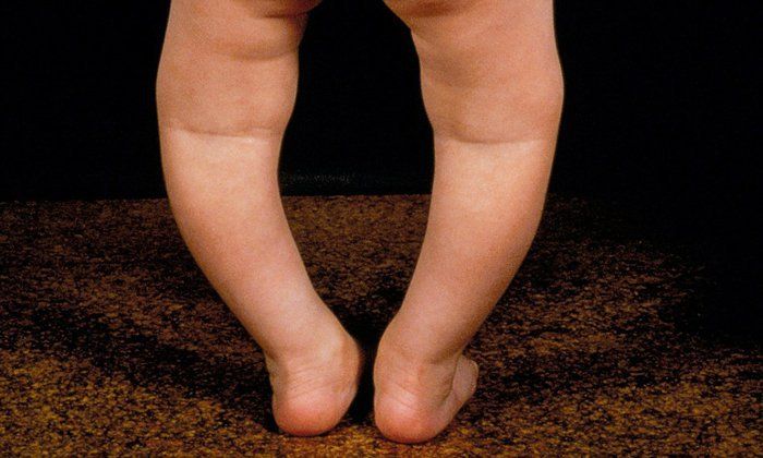 Cách khắc phục còi xương do thiếu vitamin D ở trẻ em