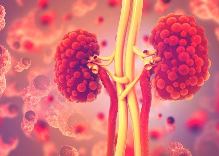 Bệnh thận đa nang ở trẻ em: Những điều cần biết